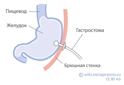 Онко Вики — Гастростома и трахеостома