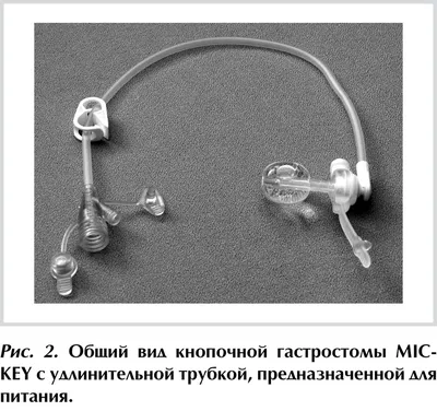 Жизнь с гастростомой | #Проблемагастростомой