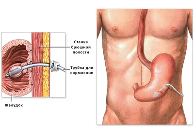 Все об энтеральном питании и гастростома
