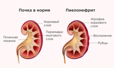 Опущение почки - симптомы и лечение - блог Медюнион