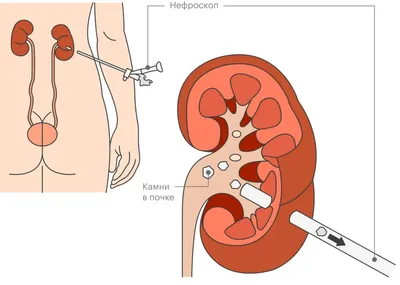 Как понять, что есть камни в почка и побороть боль - Здоровье 24