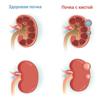 Гидронефроз почки: что это, лечение, степени, симптомы, причины | У детей и  взрослых