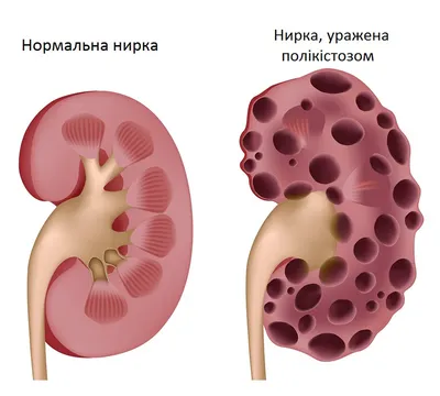 Лаборатория Invivo - Как понять, болит у вас спина или почки? 🤔 1️⃣ Первое  и самое главное отличие - это сама боль! Она не проходит, если вы поменяете  положение, сидите Вы или