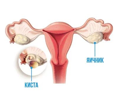 Почечная колика: симптомы и лечение