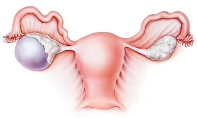 Киста яичника при беременности: опасна ли - Юнона