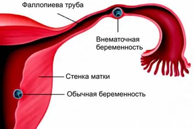 Лечение кисты почки у женщин и мужчин