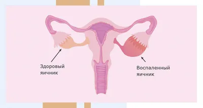 Воспаление придатков у женщин: причины, симптомы и лечение