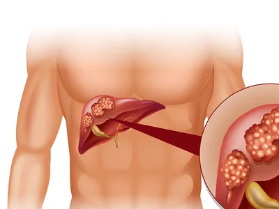Рак печени – симптомы, виды, лечение, диагностика в ФНКЦ ФМБА России