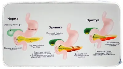 Как болит поджелудочная железа: симптомы и признаки панкреатита - Чемпионат