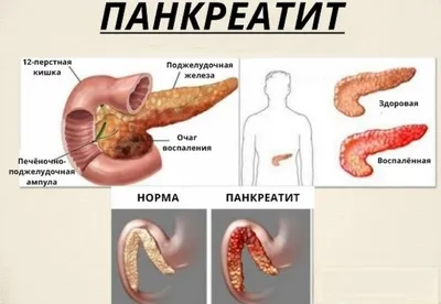 Как понять, что болит именно поджелудочная железа? Симптомы, которые многие  пропускают | Дневник здоровья | Дзен