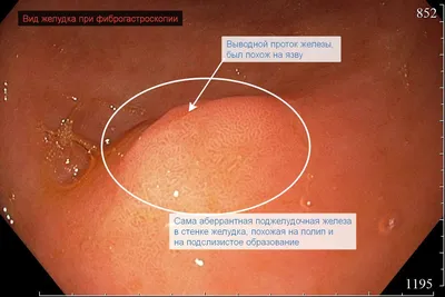 Рак поджелудочной железы: симптомы, признаки, диагностика и лечение