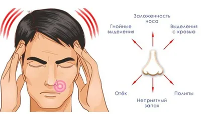 Что такое гайморит? Причины появления, симптомы и лечение