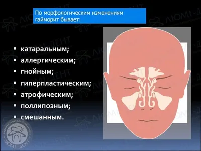 Детский Бронхолегочный Санаторий 68 ДЗМ - 😷🚑Гайморит или насморк.  Симптомы и поводы обратиться к врачу😷🚑 ⠀ Чтобы понять, что такое гайморит,  нужно разобраться в анатомии. В костях черепа существуют небольшие полости,  которые