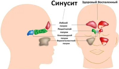 Одонтогенный гайморит (одонтогенный верхнечелюстной синусит) | НоваДент