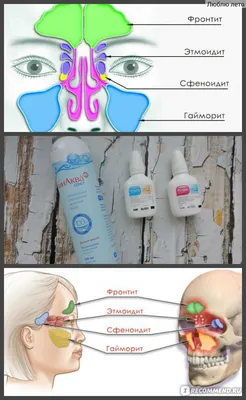 Гайморит: причины, симптомы и лечение в статье ЛОРа Зайцев В. М.