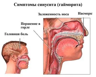 Как Лечить Гайморит (Синусит) Симптомы 100% Информации и Пользы