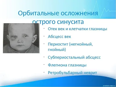 Пункция (прокол) гайморовой пазухи носа - «Запущенный гайморит - это не  гнойные сопли и боль при наклонах головы, это когда просыпаешься среди ночи  на мокрой подушке, а она в крови. Гайморит, фронтит,