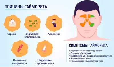 Одонтогенный гайморит (синусит): причины, симптомы, диагностика и лечение