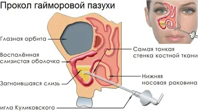 Хронический гайморит: симптомы и лечение у взрослых