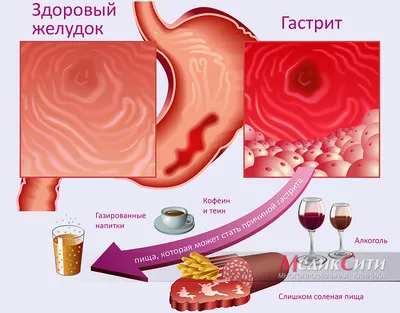 Гастрит и веганство