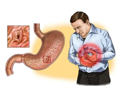Лечение хронического гастрита