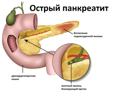 Как лечить панкреатит | spagolod.ru