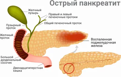 Лечение хронического панкреатита: симптомы и методы лечения