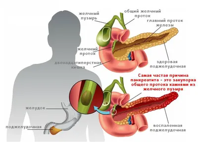 Панкреатит: причины, симптомы, признаки и диагностика панкреатита у мужчин  и женщин