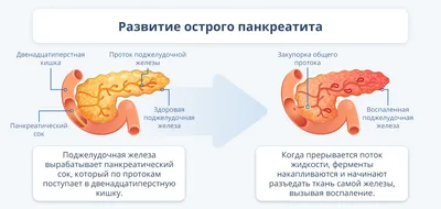 Хронический панкреатит: симптомы, причины, осложнения, диагностика в СПб