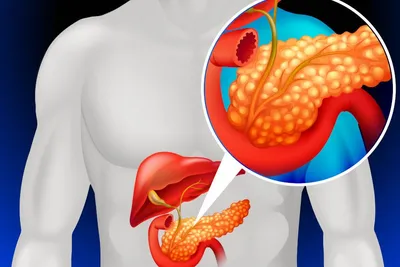 Диета при хроническом панкреатите: как правильно корректировать свое  питание? | О здоровье: с медицинского на русский | Дзен