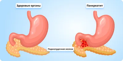 Капельницы для поджелудочной - Clean Clinic