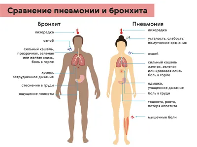 Пневмония (воспаление легких) - причины, симптомы, диагностика и лечение