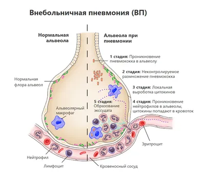 Врач о пневмонии: симптомы, диагностика и лечение воспаления легких