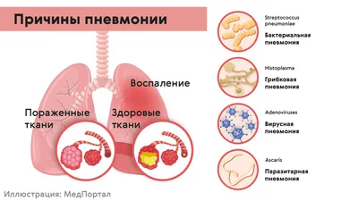 Не пропустите первые признаки пневмонии! - Единый интернет-сайт центров  социальной защиты населения