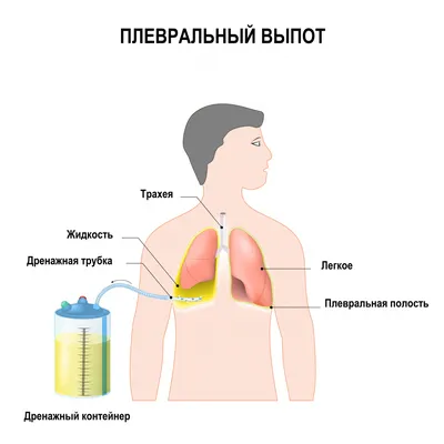 Хрипы в грудной клетке - причины появления, при каких заболеваниях  возникает, диагностика и способы лечения