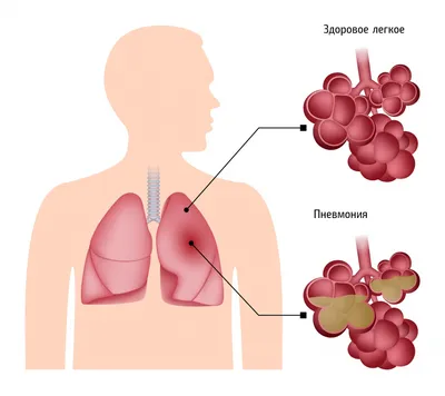 Пневмония. Причины, факторы развития и лечение