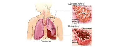 Что показывает КТ легких при коронавирусе?