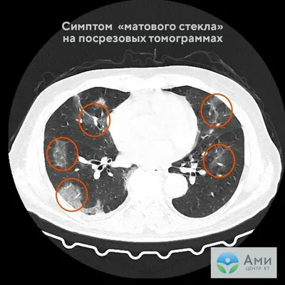 Пневмония: симптомы, лечение, диагностика, причины у взрослых и детей