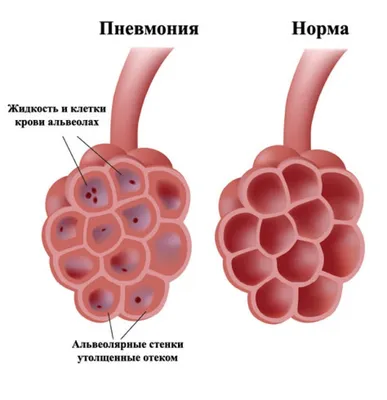 Что показывает КТ легких при коронавирусе?