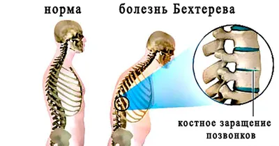 При кашле болит спина: почему может возникать боль в спине при кашле