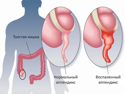 Аппендицит: с какой стороны, симптомы, признаки, диагностика, лечение