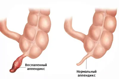 Аппендицит. Операция по удаления аппендицита в Одессе | Медицинский дом  Odrex