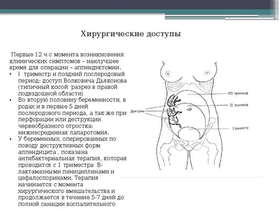 Картинка где находится аппендицит