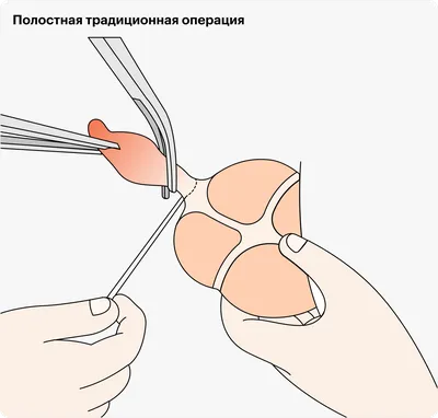 Как определить аппендицит дома: первые признаки и симптомы аппендицита -  Чемпионат