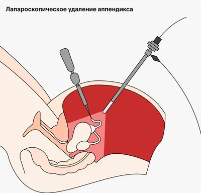 Реабилитация после аппендицита: сколько длится, осложнения, восстановление