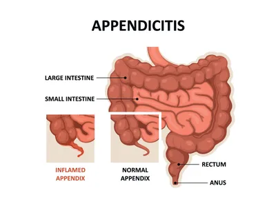 Заболевания червеобразного отростка — (клиники Di Центр)