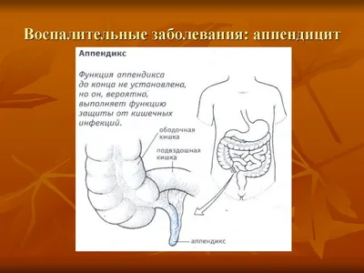 Аппендицит - причины появления, симптомы заболевания, диагностика и способы  лечения