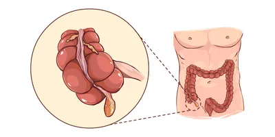Что такое аппендицит, и нужен ли нам вообще аппендикс?