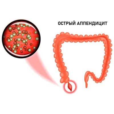 Аппендицит у взрослых: причины, симптомы, лечение, профилактика в домашних  условиях