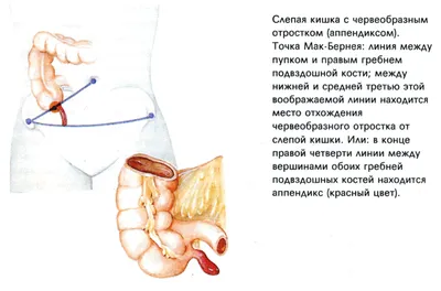 Аппендицит: с какой стороны, симптомы, признаки, диагностика, лечение